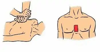 下图所示为胸外心脏按压法的正确做法。